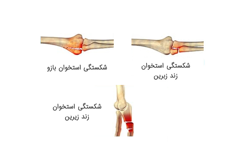 انواع شکستگی آرنج