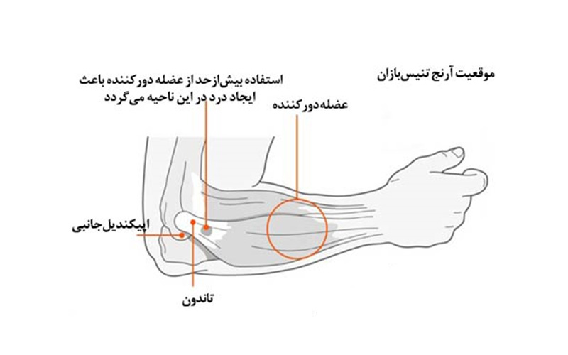 آرنج تنیس‌بازان (اپی کندیلیت جانبی)