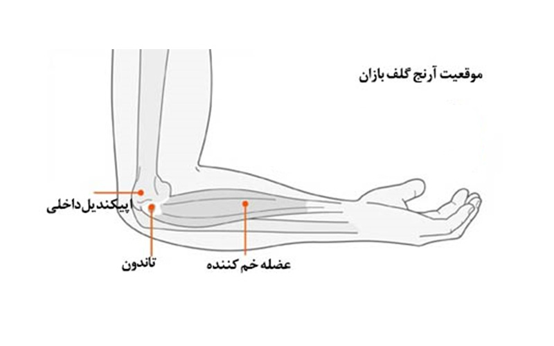 بیماری آرنج گلف‌بازان (اپی کندیلیت میانی)