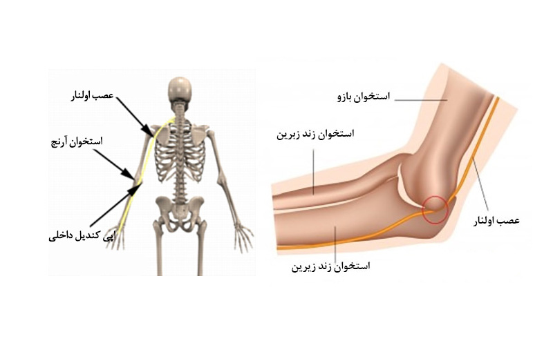 گیر افتادن عصب آرنج